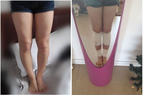 Before and After Picture of Legs of A Girl Who Had Bowed Legs Corrective Surgery.